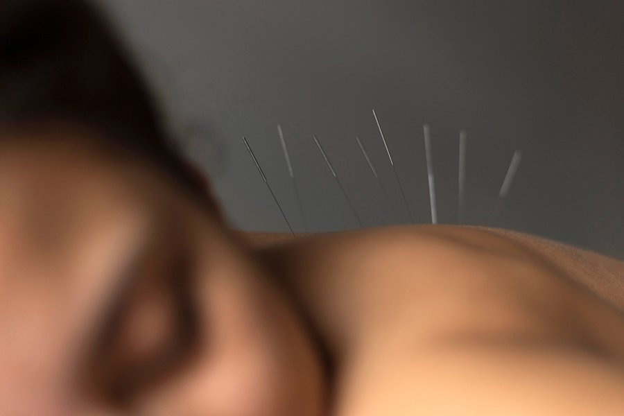 Acupuncture Could Help You Finally Manage Your Stress Levels